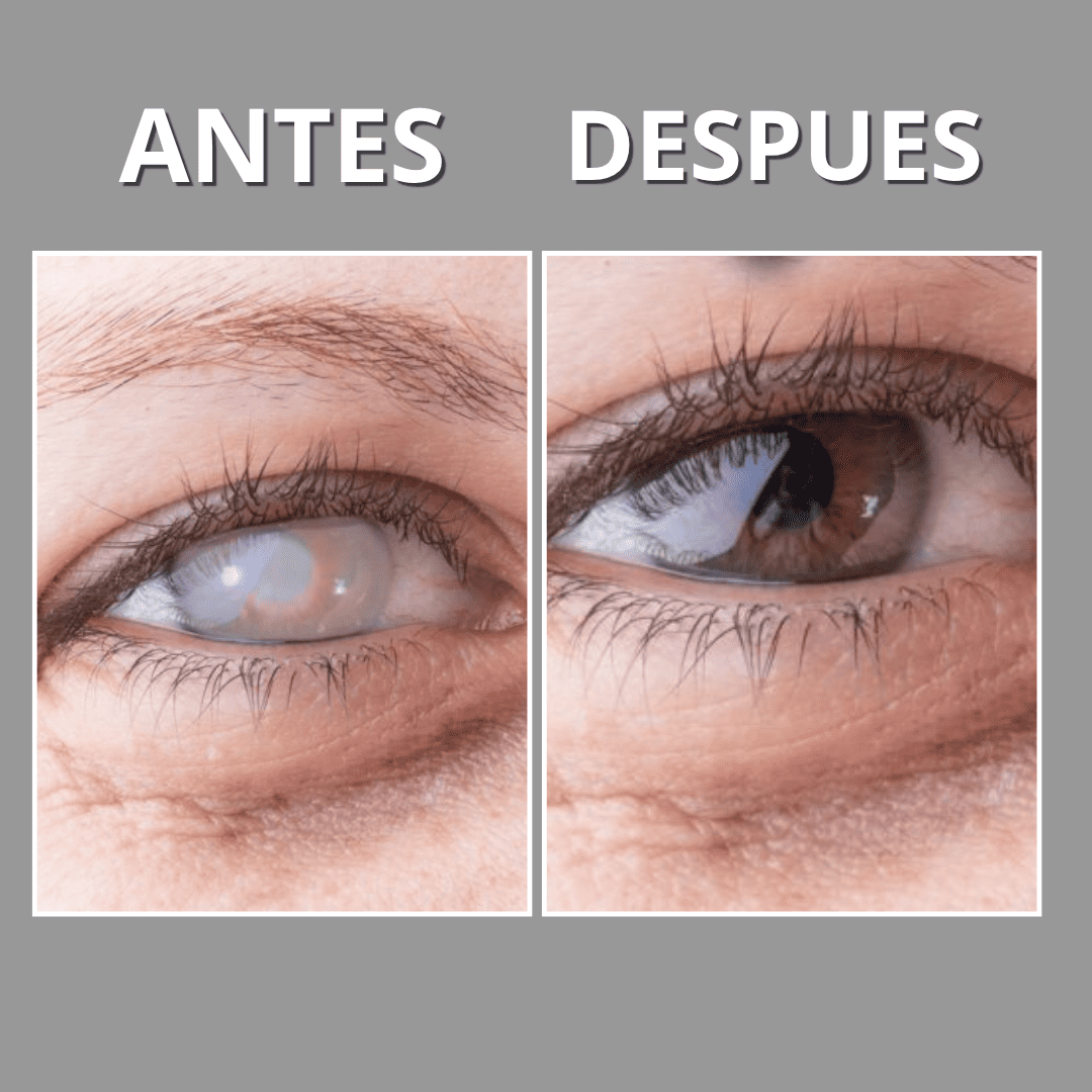 Oftalmiel™ Tratamiento Ocular Homeopatico 100% Natural